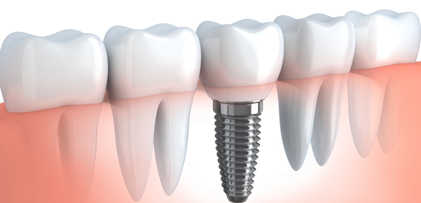 Ce-sunt-implanturile-dentare