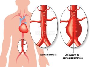 Ce este aorta abdominala si ce probleme comune are?